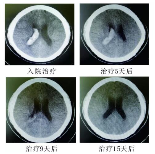 腦出血你不得不引起重視的疾?。。?！