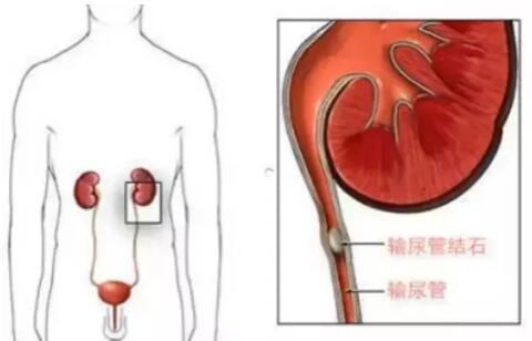 輸尿管結石，到底能不能保守治療？