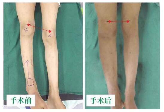 女孩墜梯右腿縮短5cm，幸得醫(yī)生及時診治恢復正常腿型