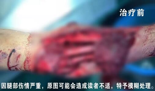 感謝安利醫(yī)院挽救了我的腿，沒(méi)有讓我落下殘疾……”