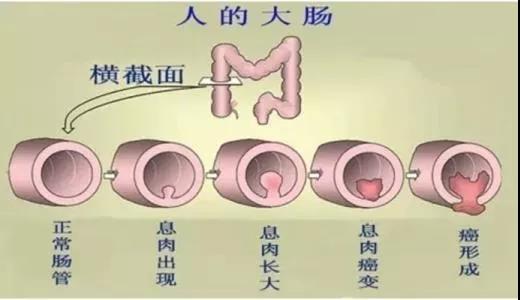 體檢發(fā)現(xiàn)腸息肉會(huì)癌變嗎？