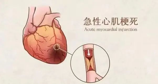 【保山安利醫(yī)院】11月20日“心梗救治日” 時間就是心肌，時間就是生命！